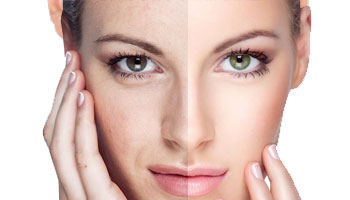 Facial Rejuvenation