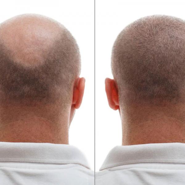 Hair Transplant